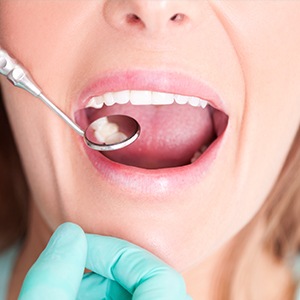 Closeup of patient during dental exam
