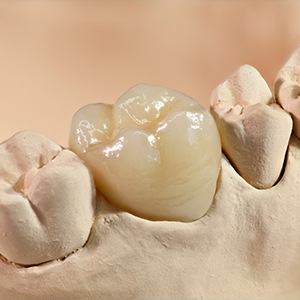 Model smile with dental crown restoration