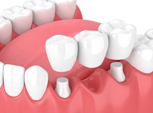 dental bridge in Santa Ana