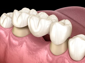 dental bridge
