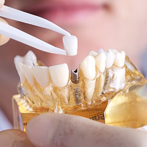 Model of implant supported dental crown