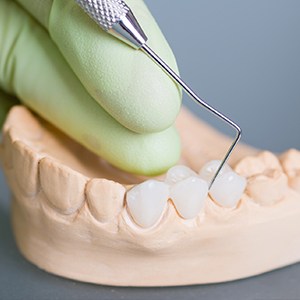 Model smile with fixed bridge restoration