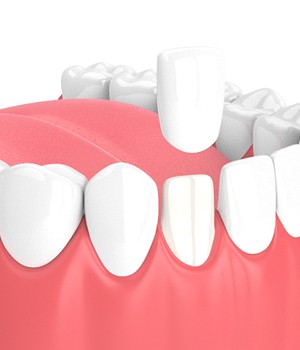 Porcelain veneers