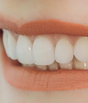 Smiling with veneers