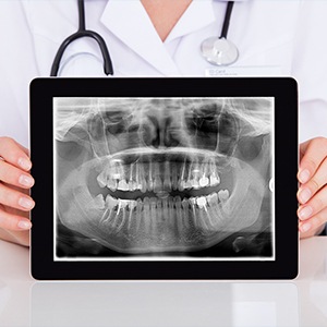 Panoramic dental x-rays