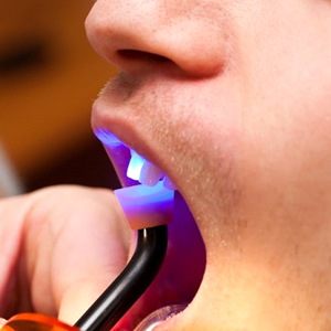 dentist using curing light to harden tooth-colored filling