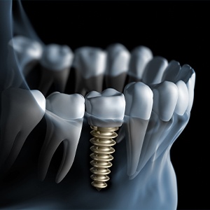 A close up of an implant in the mandible