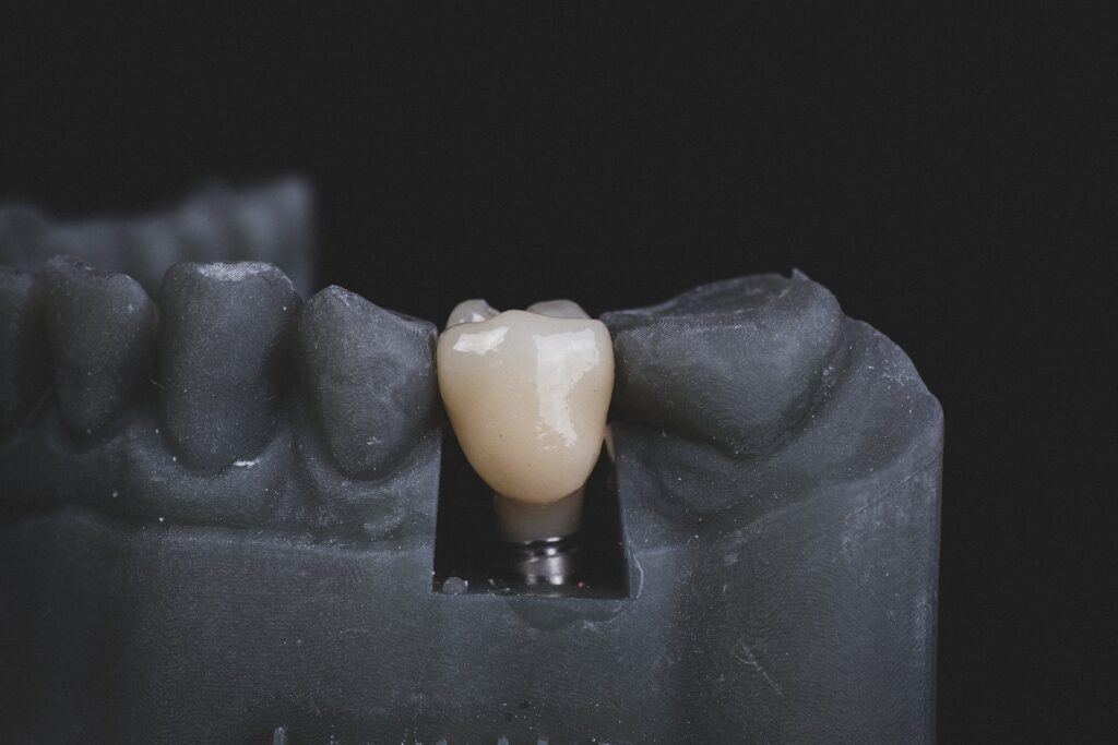 A tooth implant is placed in the center of a black cast.