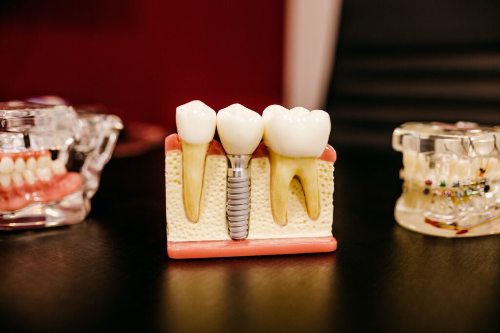 A tooth implant model on top of a table.