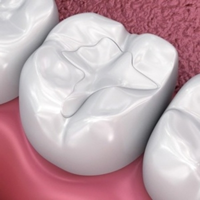 A close up of the teeth with porcelain fillings