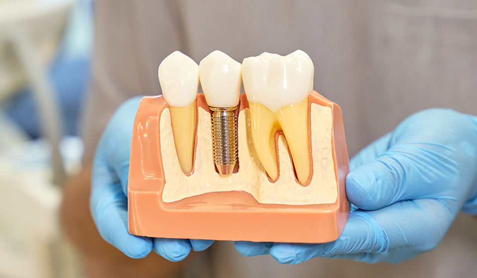A model of teeth and implants in the hands.